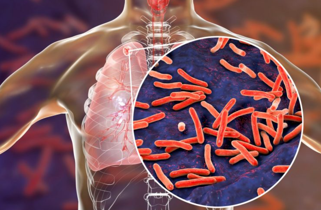 Aumentaron un 38% los casos de tuberculosis en Argentina